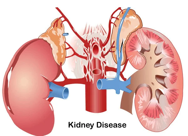 Kidney Issues
